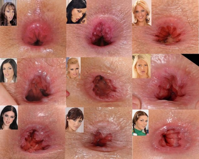 anal
