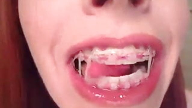 sexy redhead braces