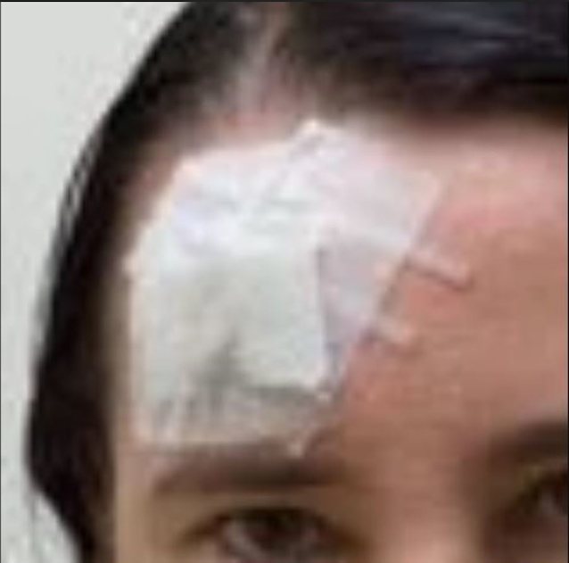 brain injury cockasian blonde