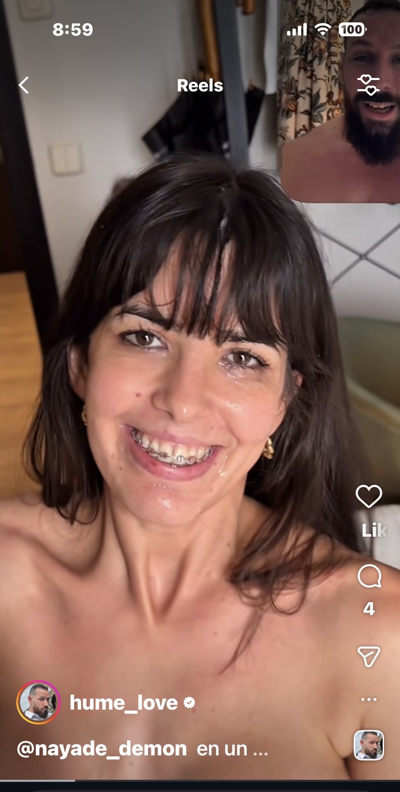 braces come in face money