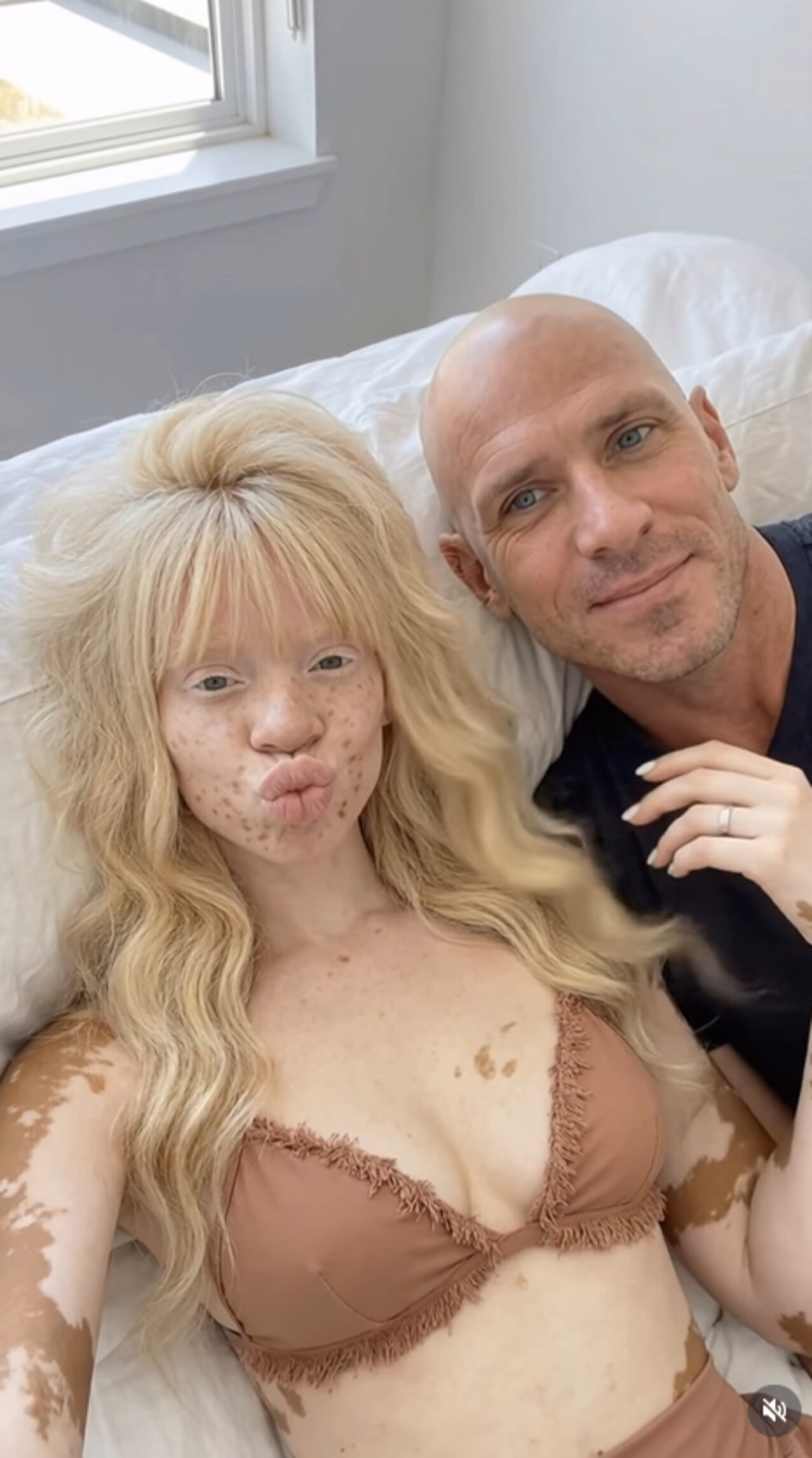 vitiligo blonde straight