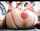 prolapse anal cam